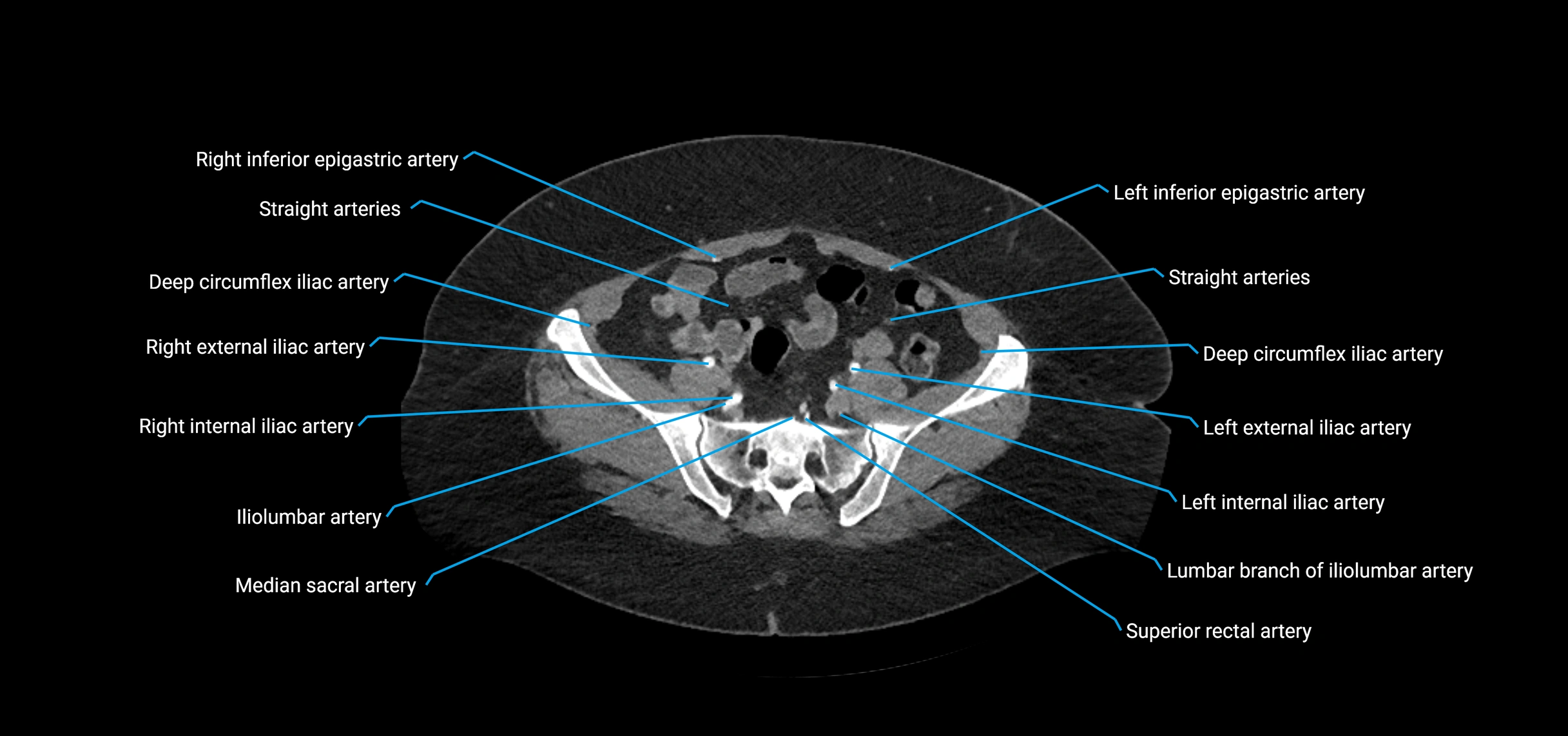 CTA abdomen axial cross sectional anatomy labelled image_191 (2).webp